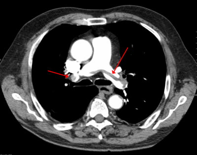 Pulmonary Thrombo-embolism/ Coming soon