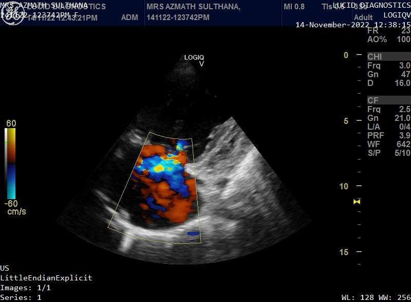 Primary pulmonary hypertension